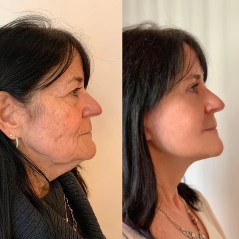 Marlene Rivera - Antes e depois